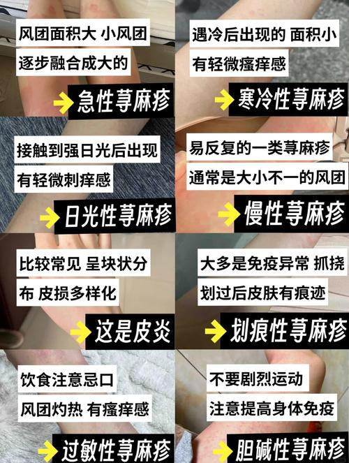 《荨麻疹高发季来临,免疫紊乱、感染与过敏原是三大主因》