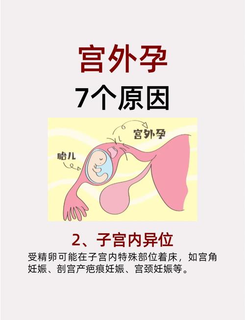 宫外孕频发背后:输卵管炎症成首要元凶