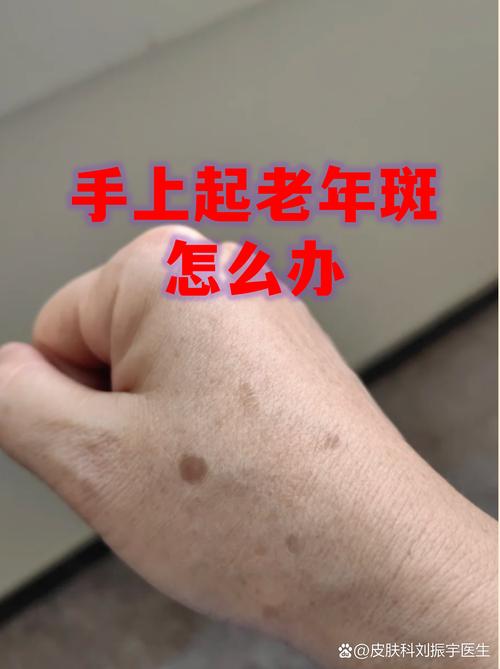 手上长老年斑的真相:不只是衰老,或与日晒和遗传有关