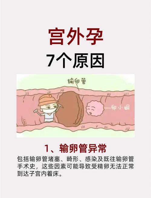 宫外孕频发背后:输卵管炎症成首要元凶