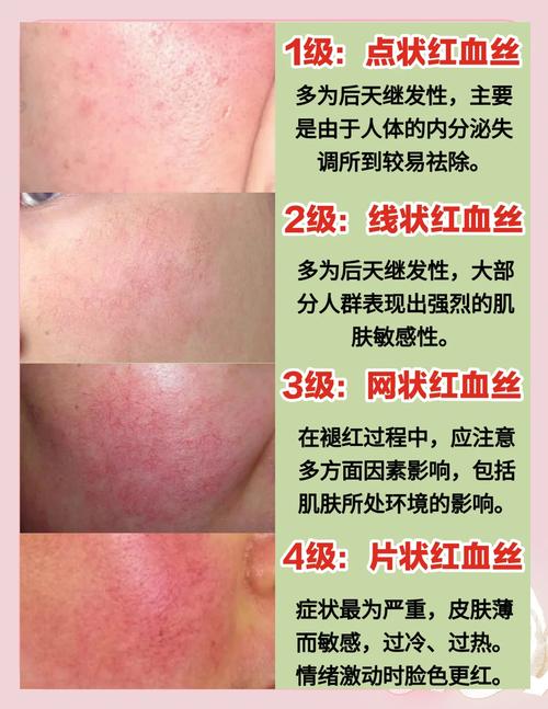 “换季脸通红”?专家解析面部红血丝成因与防护要点