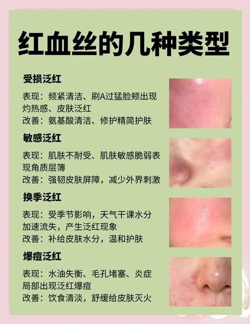 “换季脸通红”?专家解析面部红血丝成因与防护要点