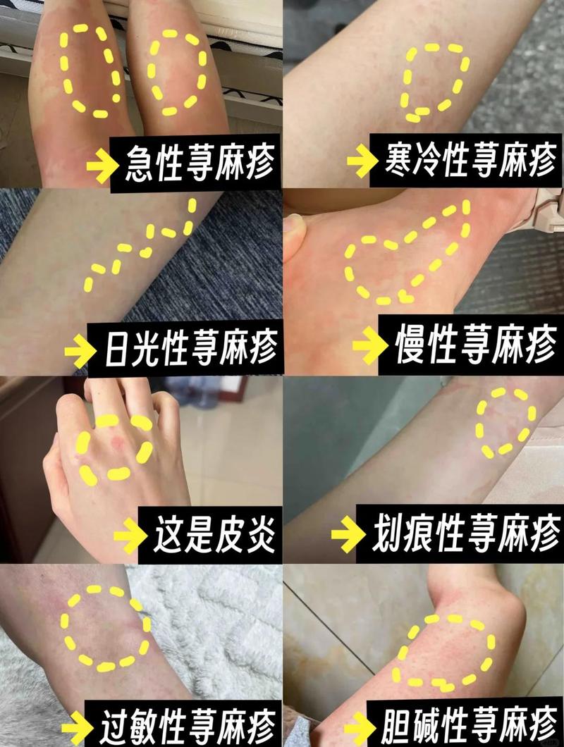 《荨麻疹高发季来临,免疫紊乱、感染与过敏原是三大主因》